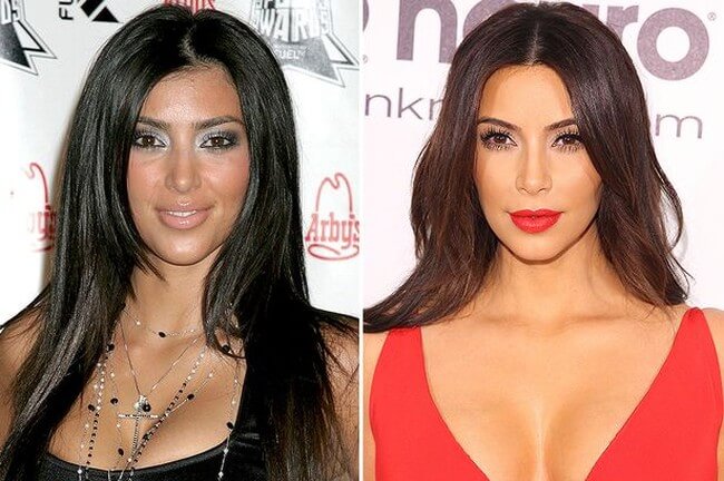 Kim Kardashian before after plastic surgery