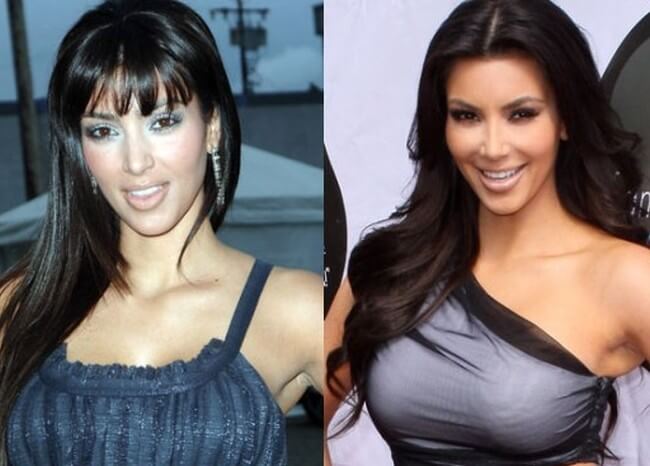kim kardashian before after plastic surgery 2