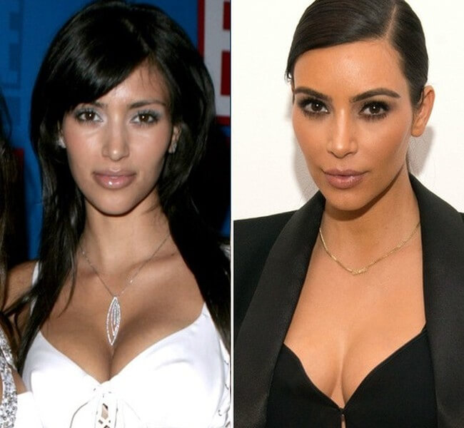kim kardashian before after plastic surgery 2005 2014