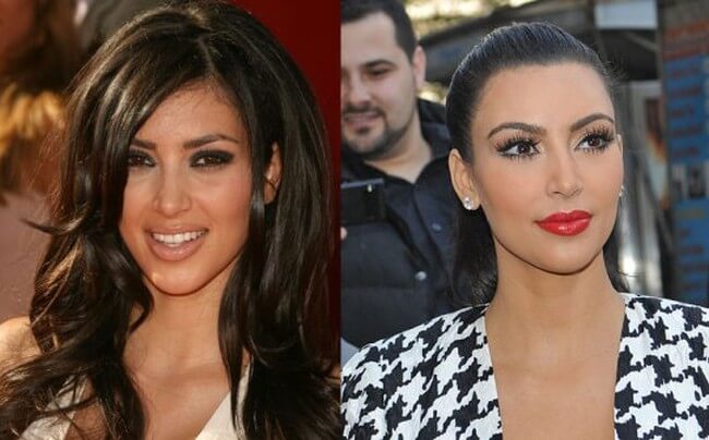 kim kardashian before after plastic surgery 3