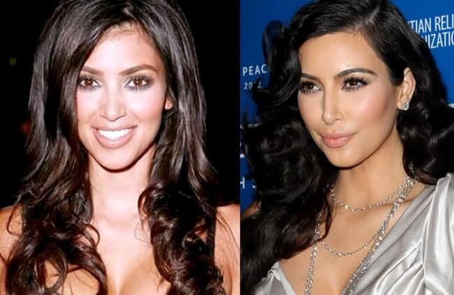 kim kardashian before after plastic surgery 5